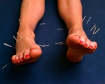 acupuncture, needles in feet, 